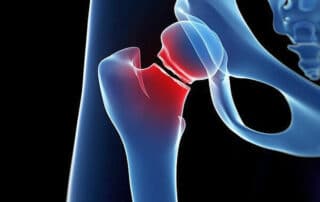 Os fracture